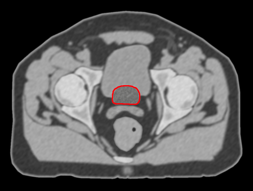 ARD PROSTATE CONTOUR CANCER