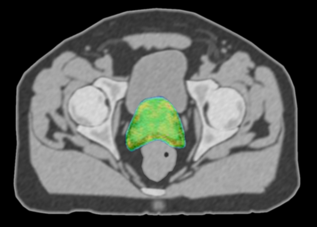 ABSOLUTE REMOTE DOSIMETRY PROSTATE ISODOSE CLOUD